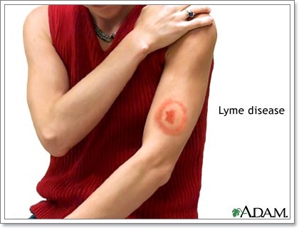 Dogilike.com ::  (Lyme disease) ä¨ҡ 褹ѡعѢͧѧ
